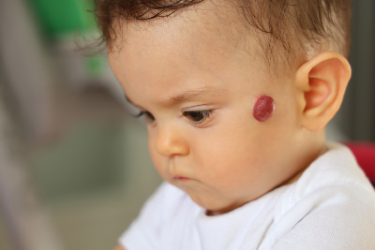 Hemangioma on the face of a baby
