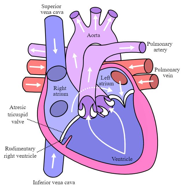 Pediatric Tricuspid Atresia - Conditions and Treatments | Children's ...