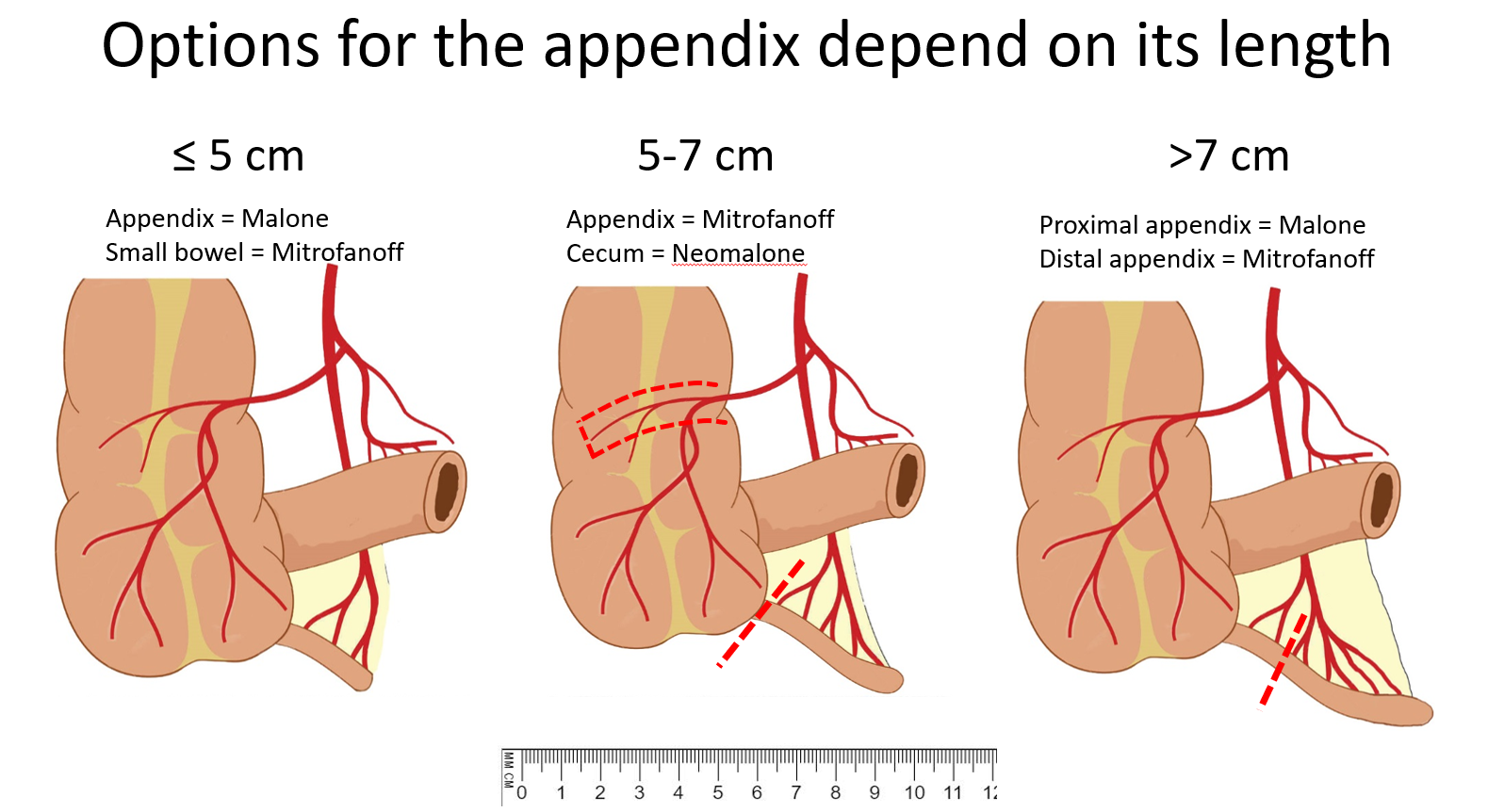 Malone appendicostomy options for the appendix