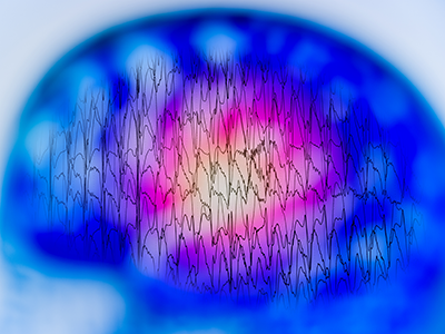 EEG with electrical activity of abnormal brain