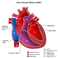 Illustration of the anatomy of a heart with an atrial septal defect