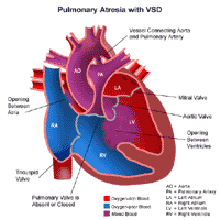Anatomy of a heart with pulmonary atresia with VSD