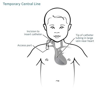 Temporary Central Venous Catheter diagram