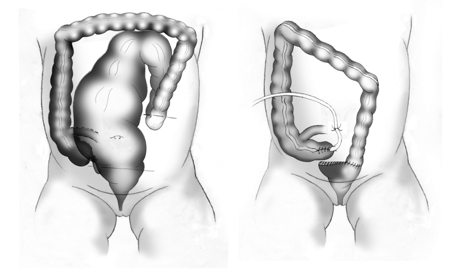 pediatric cecostomy tube illustration