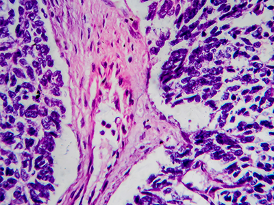 light micrograph of wilms tumor