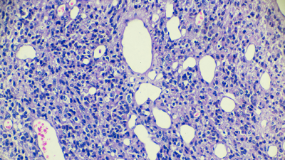 Germ cell tumor of testicle under microscopy