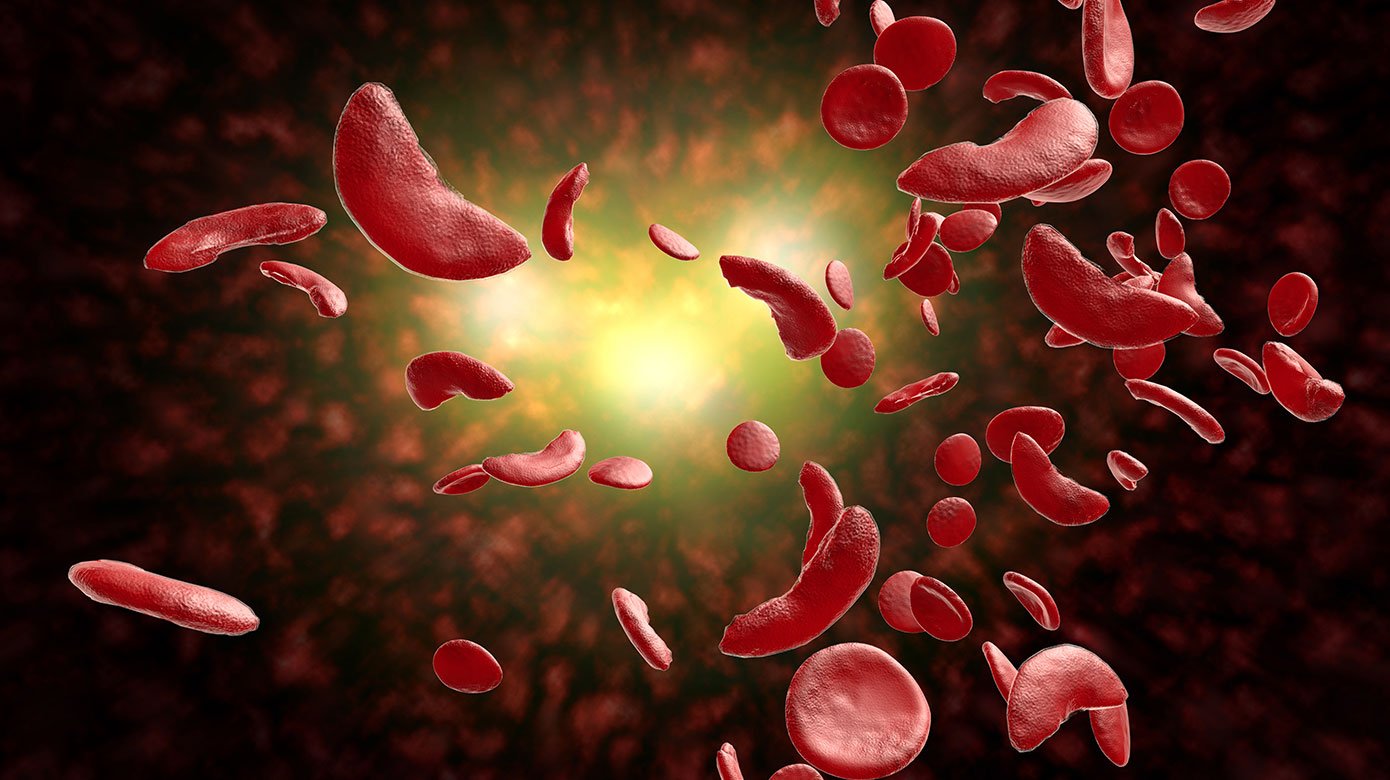 illustration of blood cells with sickle cell anemia