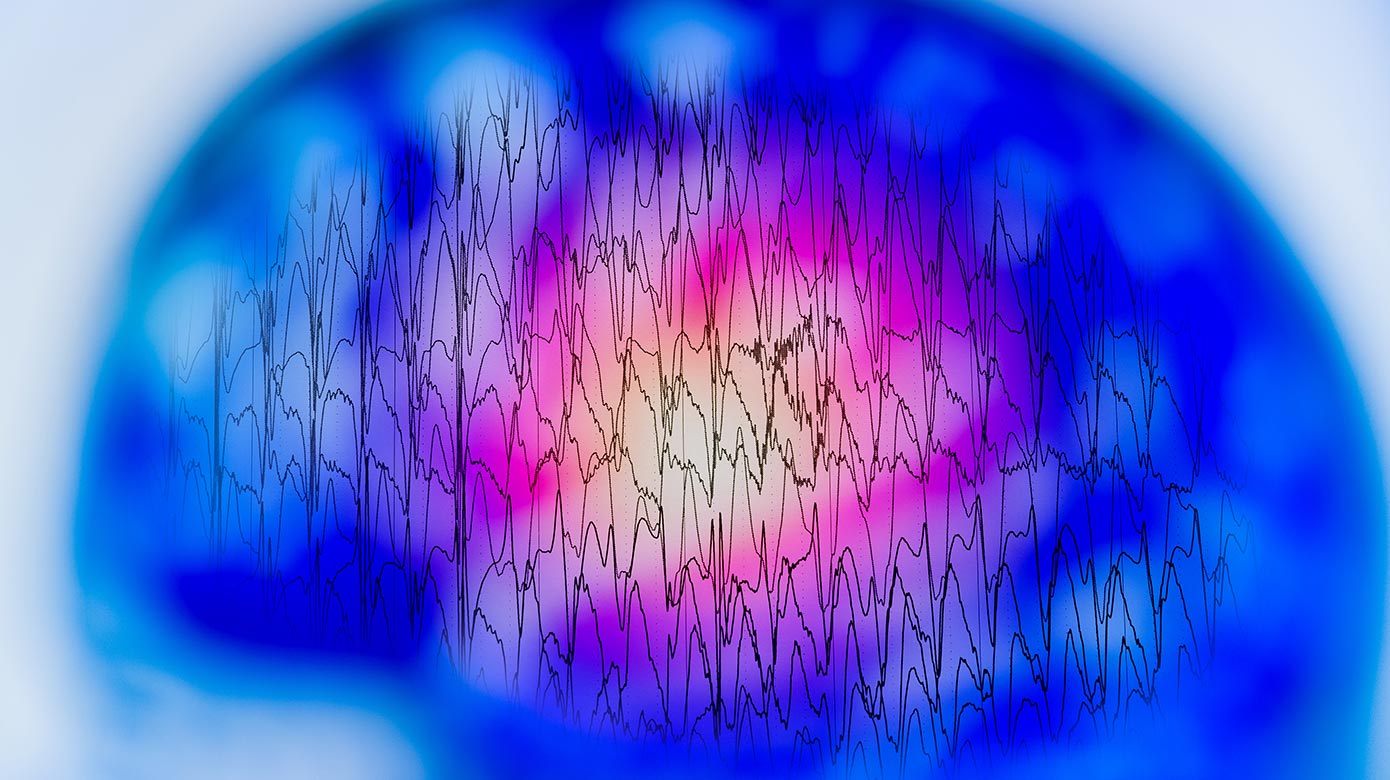 EEG with electrical activity of abnormal brain