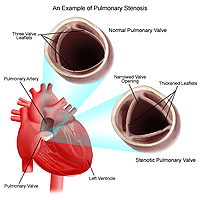 Illustration of pulmonary stenosis